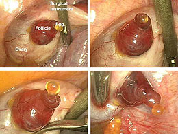 ovulation Captured on film - the moment of ovulation