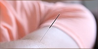 yinova-acupuncture