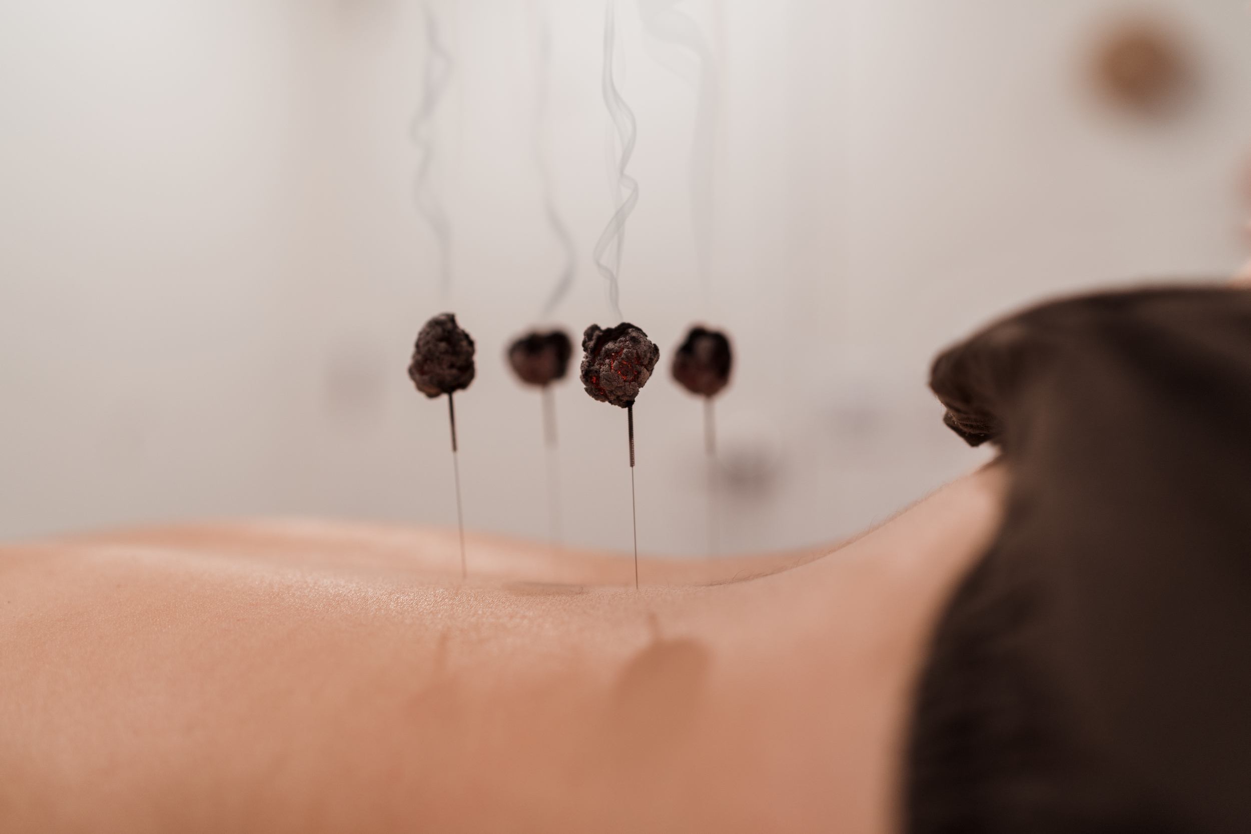 A patient laying face down on a table with 4 acupuncture needles in their lower back. on top of the needles is some dried moxa, which has been heated to provide warmth