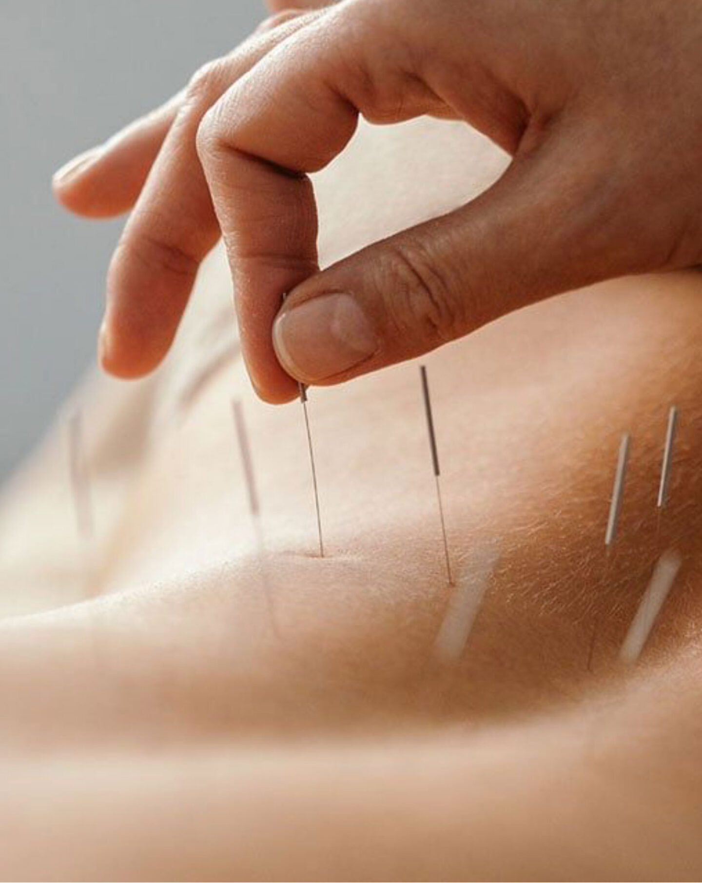 Acupuncture Restores the Connection