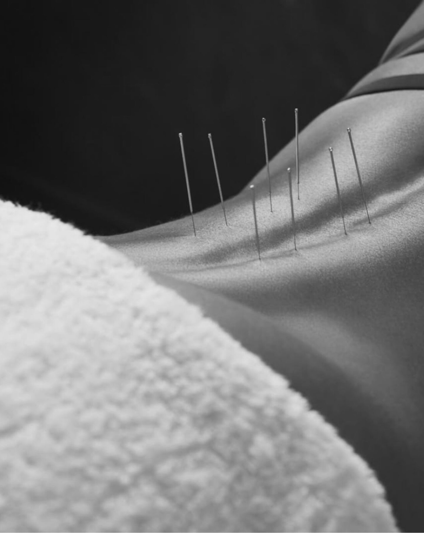Acupuncture for Perimenopause